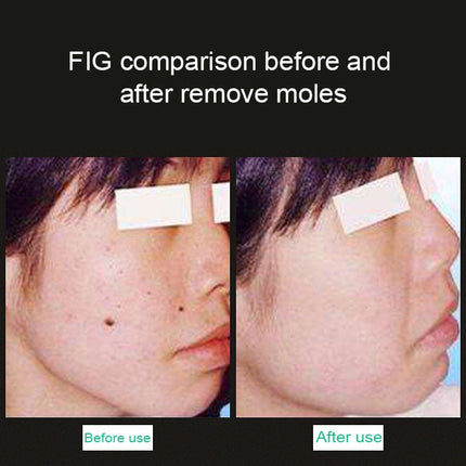 Handheld Picosecond Portable (Removing Tattoo Freckle Mole Dot)  Machine Laser Plasma Beauty Care Pen, USB / Blue Light, USB /  Red Light