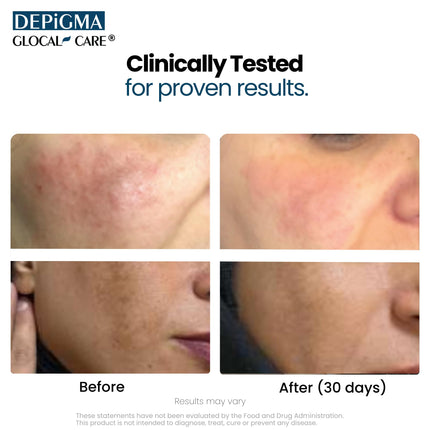 GlocalCare Depigma Support Reduction of Hyperpigmentation, Melasma & Dark Spots with Glutathione, Polypodium Leucotomos, Grape Seed & Marigold Extract